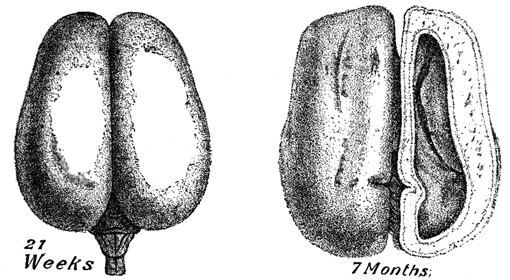 Two brains described in text (21 weeks and 7 months).