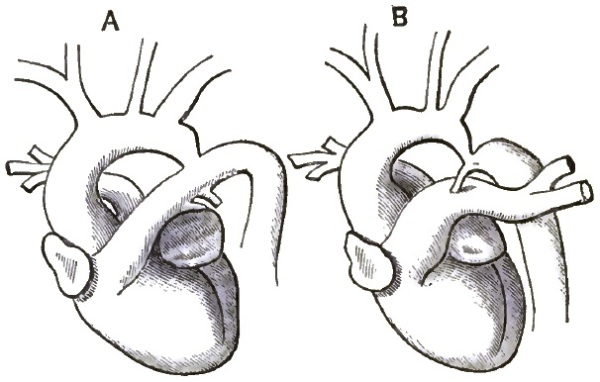 Heart diagrams